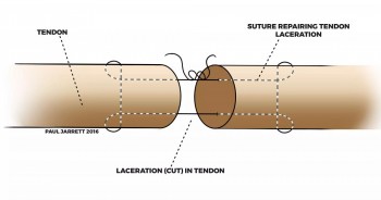 Operația de tendon la mână